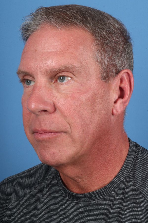 Facelift Before & After Image