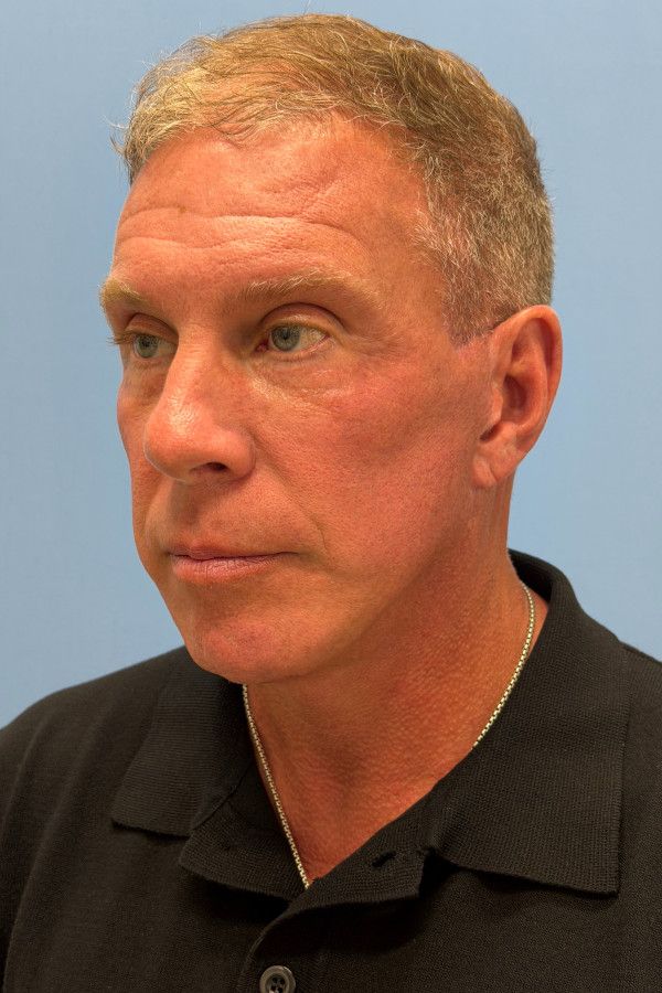 Facelift Before & After Image