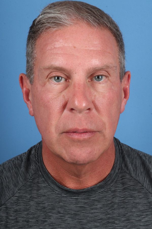 Facelift Before & After Image
