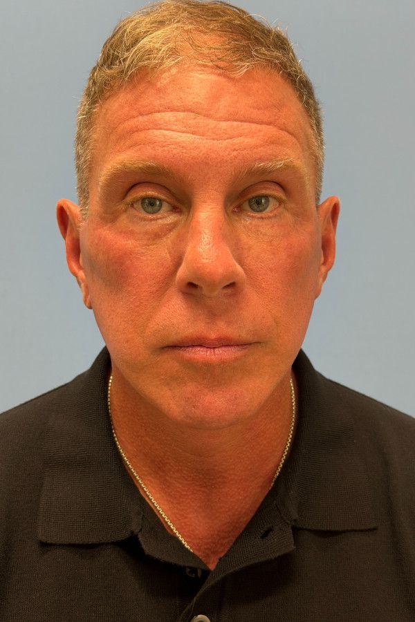 Facelift Before & After Image