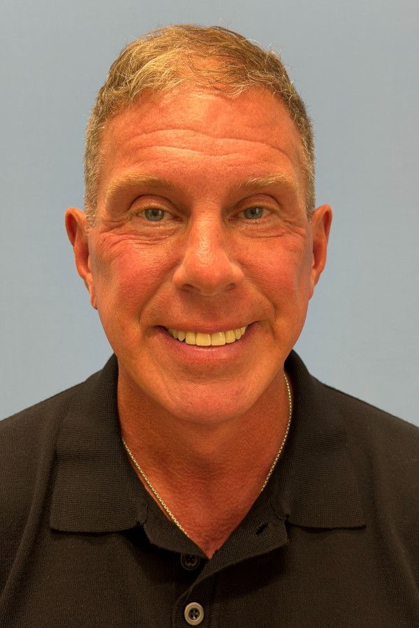 Facelift Before & After Image