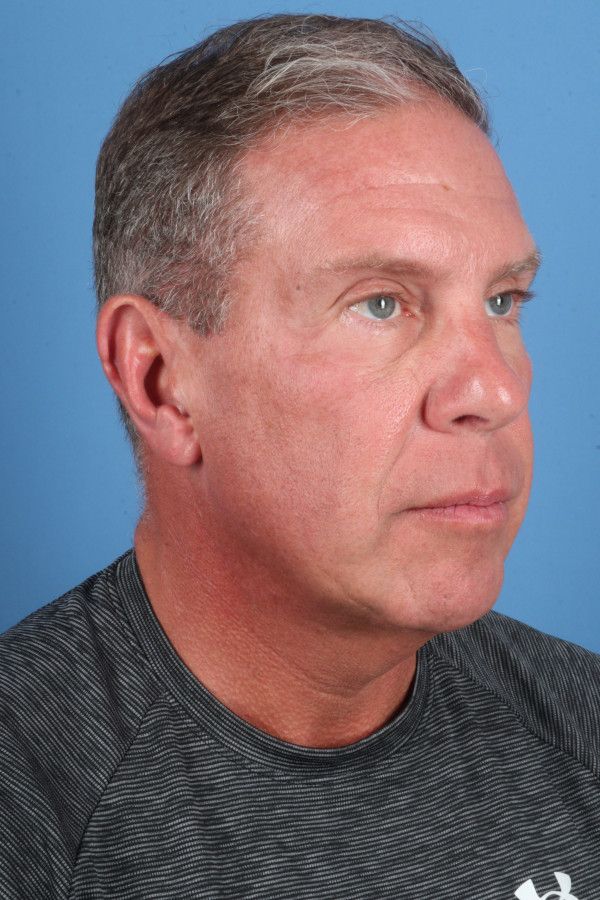 Facelift Before & After Image