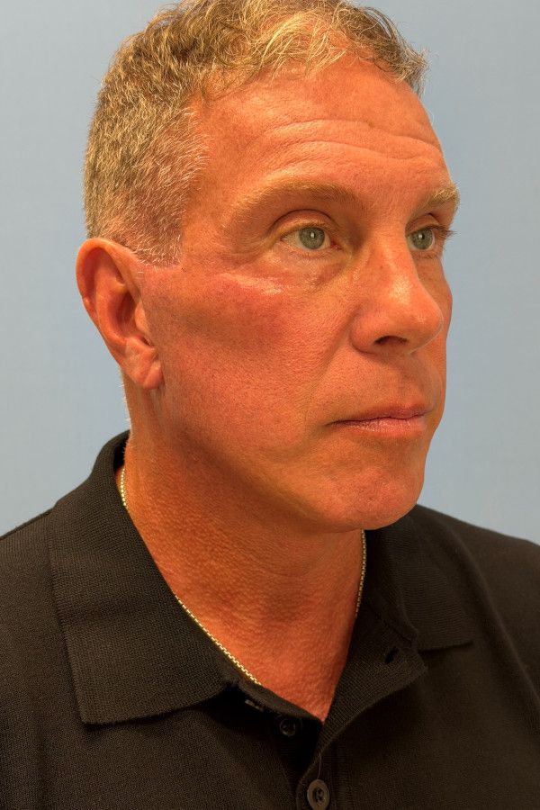 Facelift Before & After Image