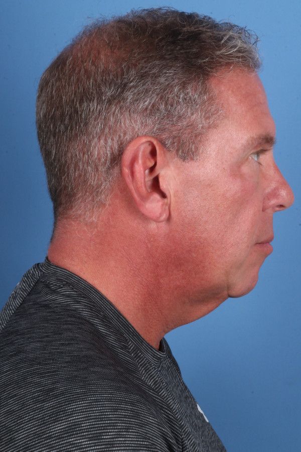 Facelift Before & After Image