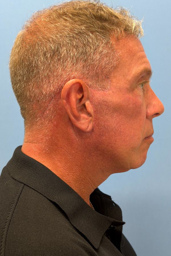 Facelift Before & After Image