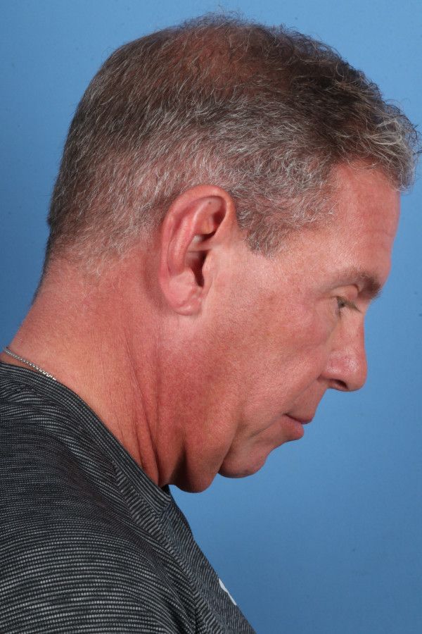 Facelift Before & After Image