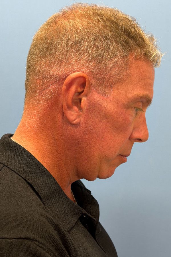 Facelift Before & After Image
