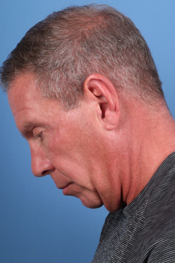 Facelift Before & After Image