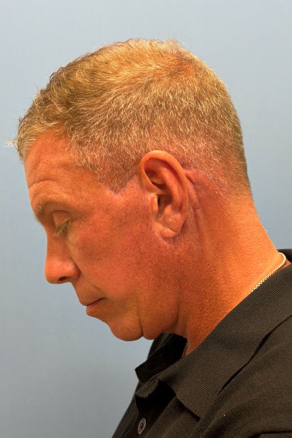 Facelift Before & After Image