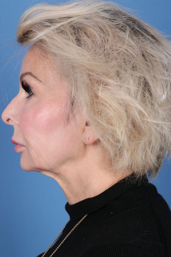 Facelift Before & After Image