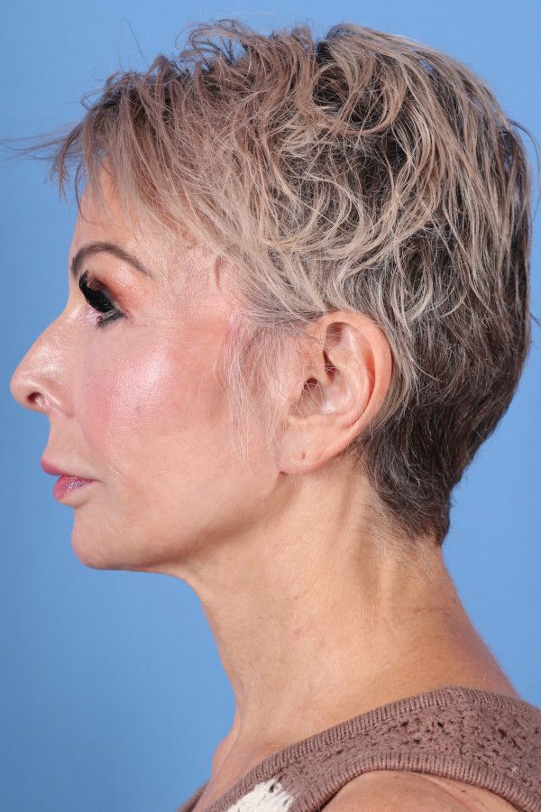 Facelift Before & After Image