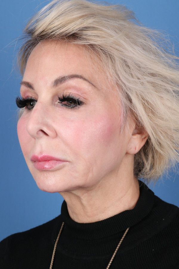 Facelift Before & After Image
