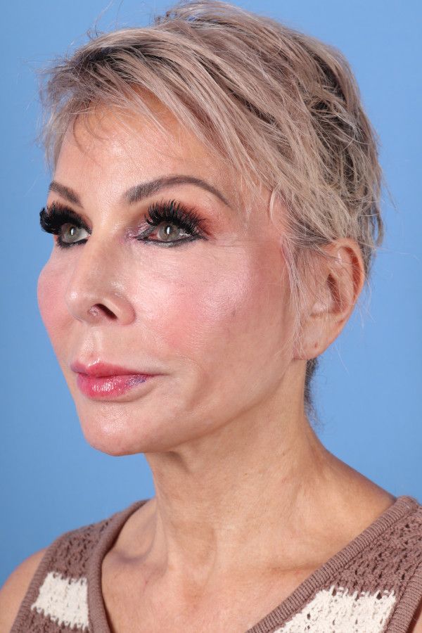 Facelift Before & After Image