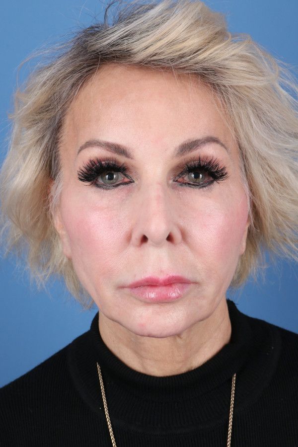 Facelift Before & After Image