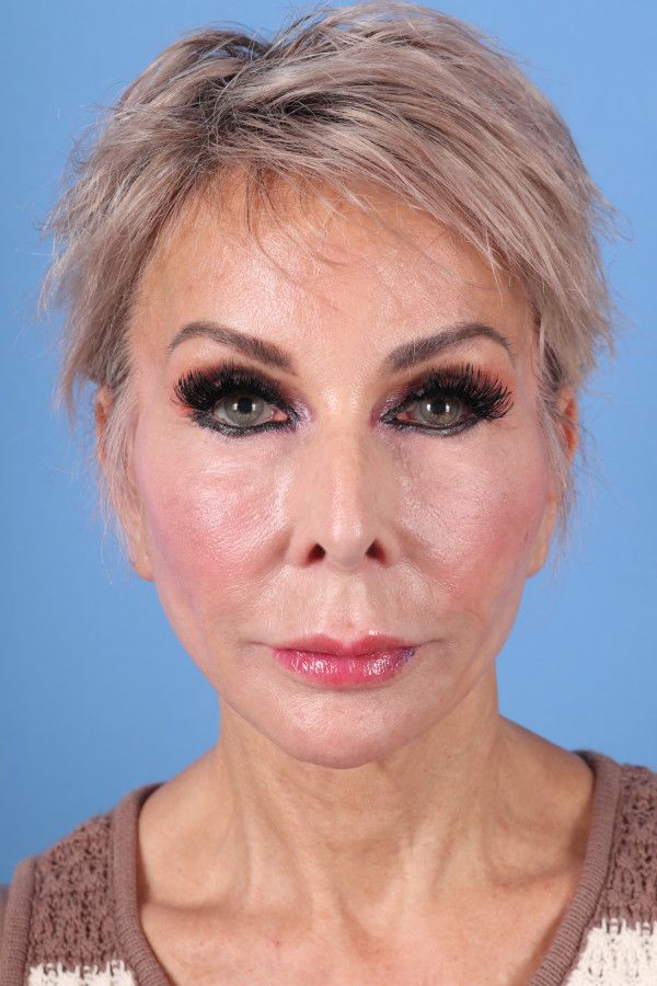 Facelift Before & After Image