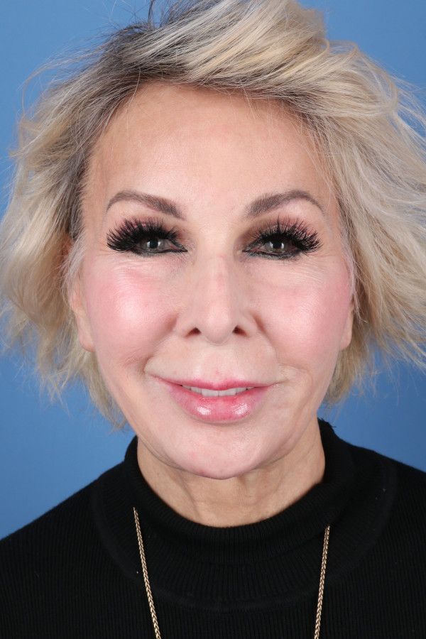 Facelift Before & After Image