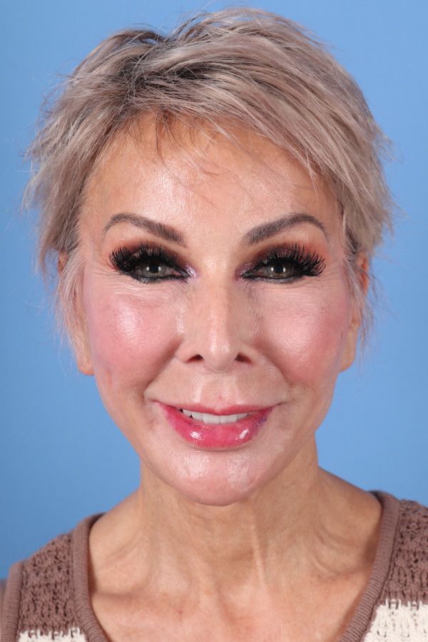 Facelift Before & After Image