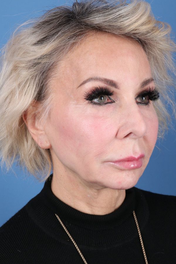 Facelift Before & After Image