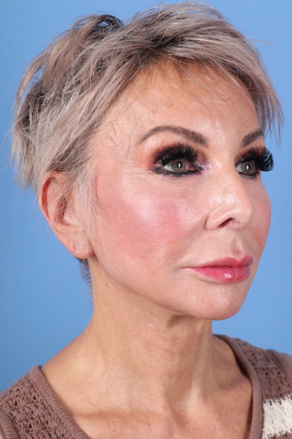 Facelift Before & After Image