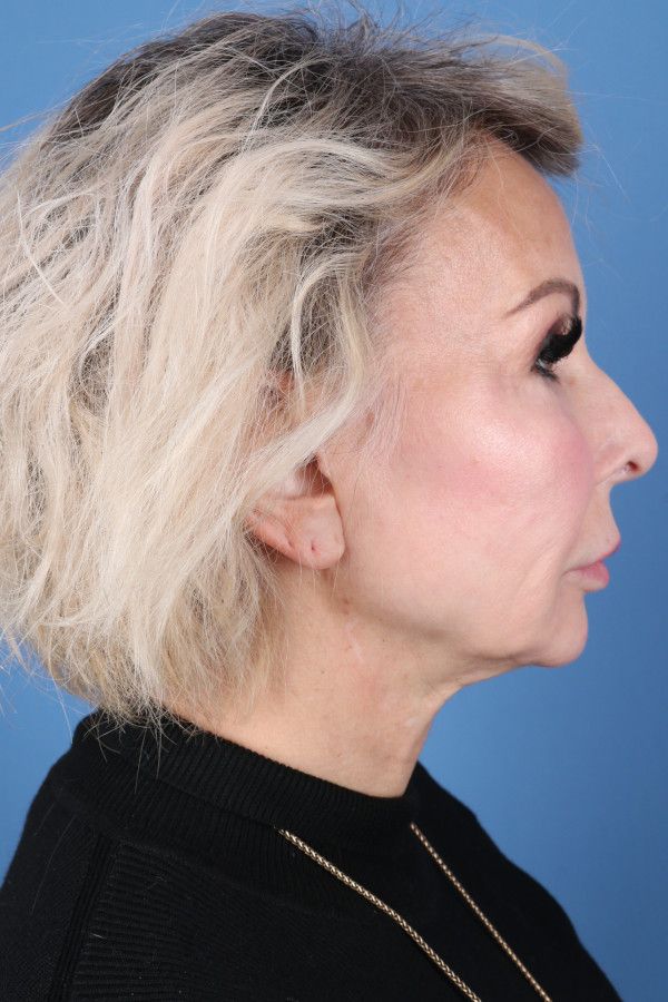 Facelift Before & After Image