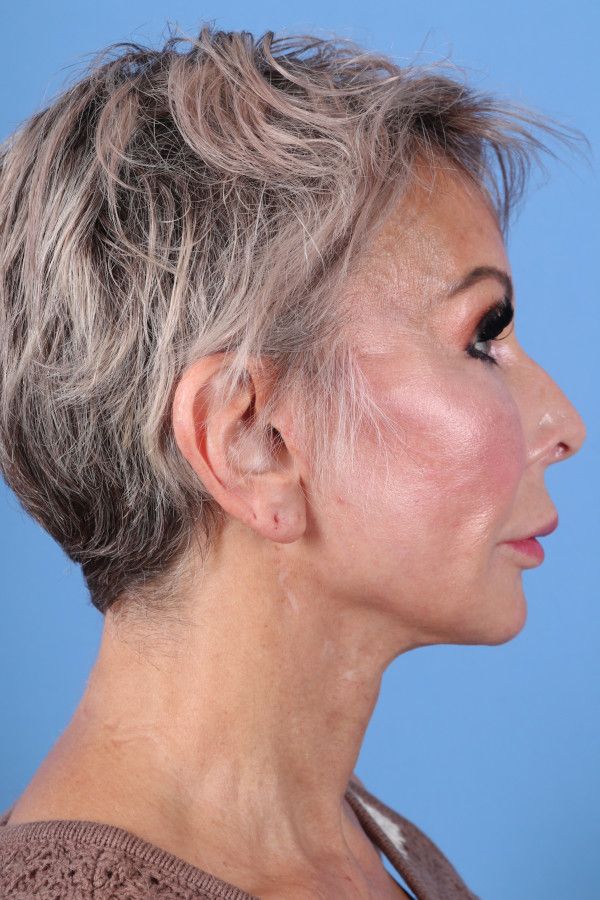 Facelift Before & After Image