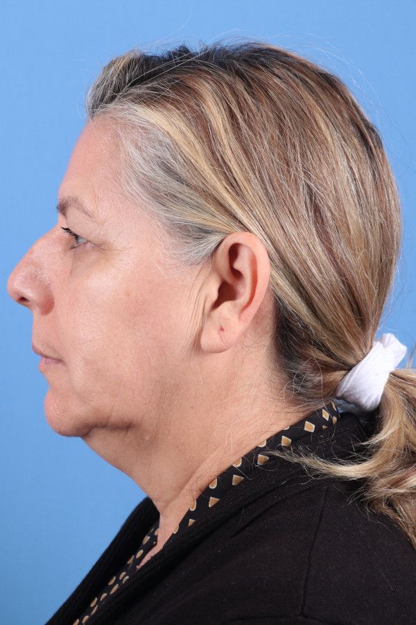 Facelift Before & After Image