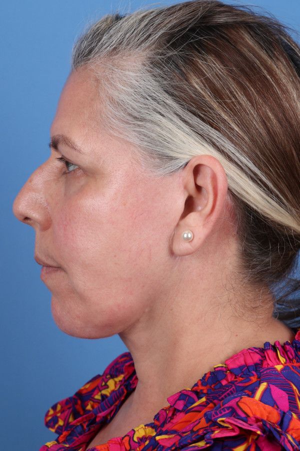Facelift Before & After Image