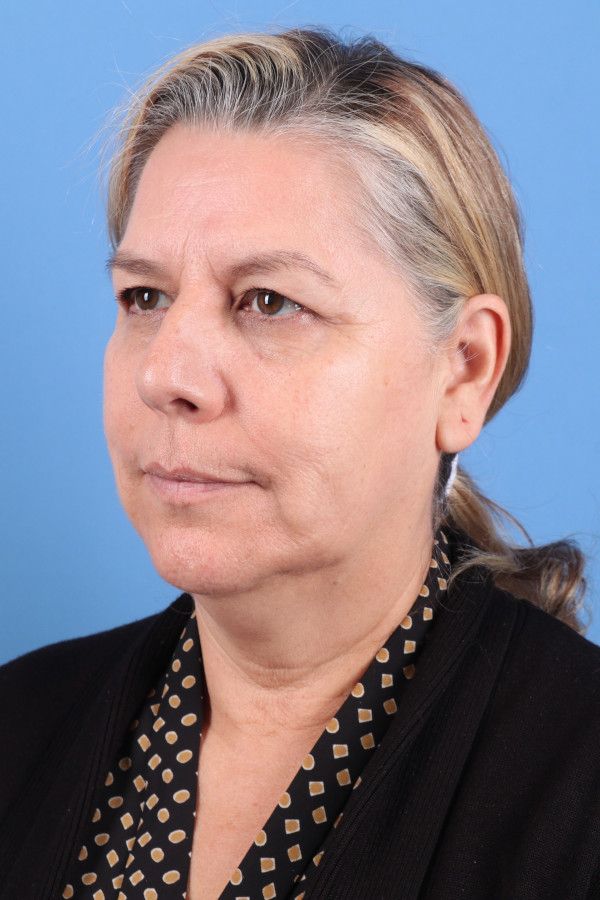 Facelift Before & After Image