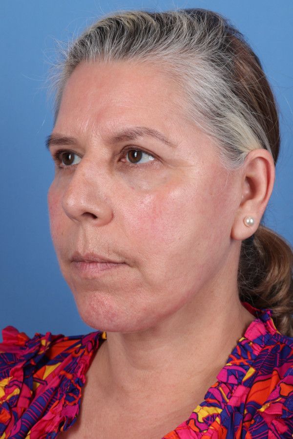 Facelift Before & After Image