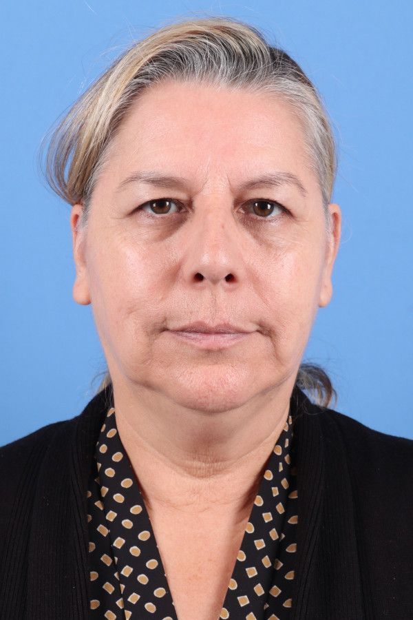 Facelift Before & After Image