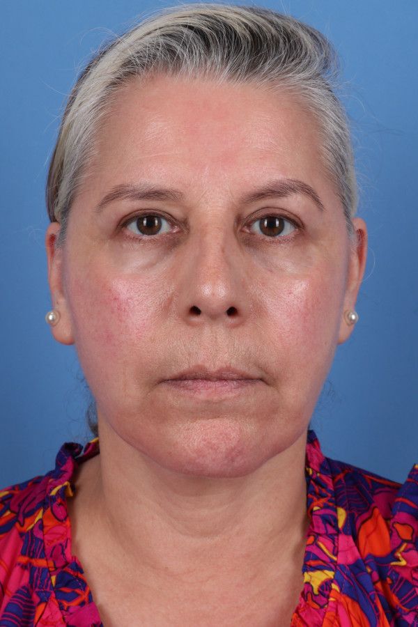 Facelift Before & After Image