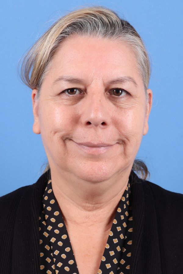 Facelift Before & After Image