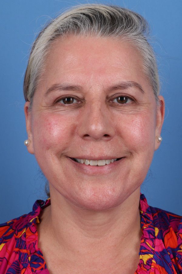 Facelift Before & After Image