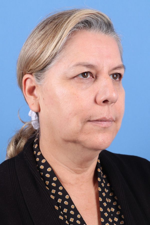Facelift Before & After Image