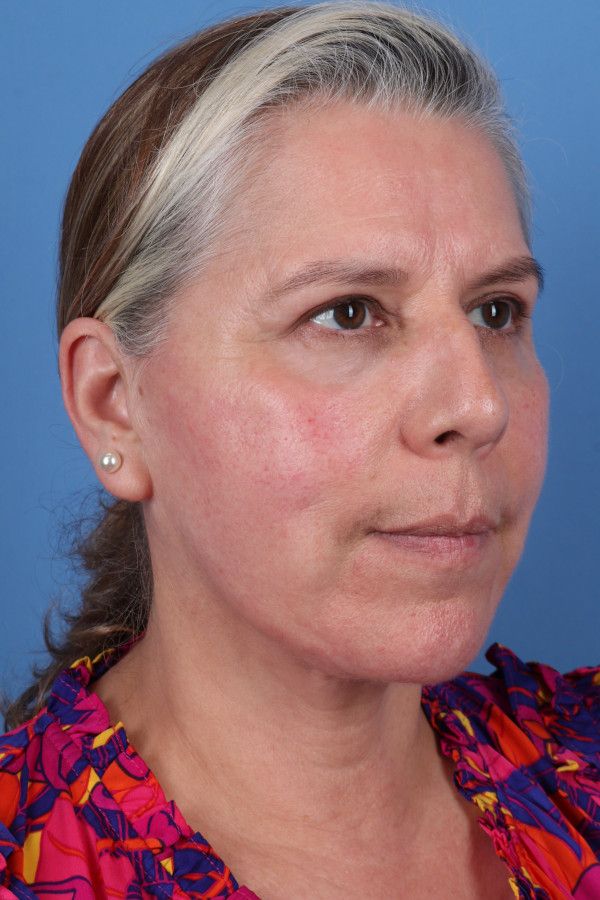Facelift Before & After Image