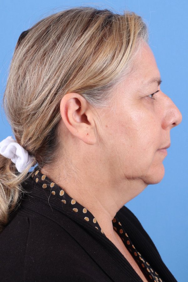 Facelift Before & After Image