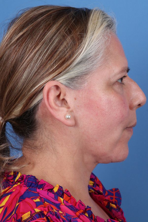 Facelift Before & After Image