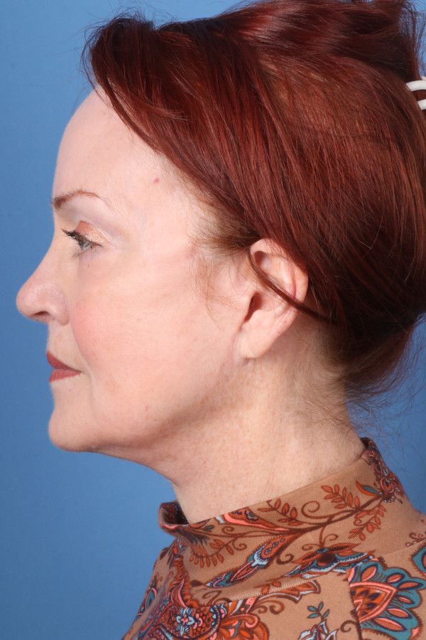 Facelift Before & After Image