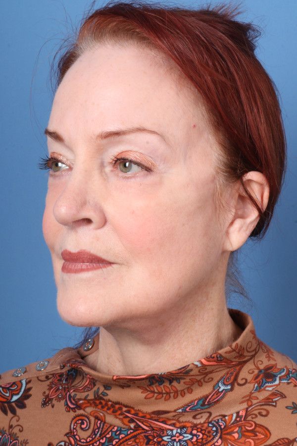 Facelift Before & After Image
