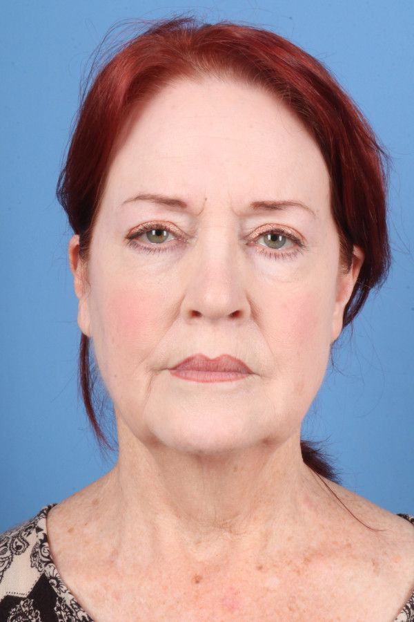 Facelift Before & After Image