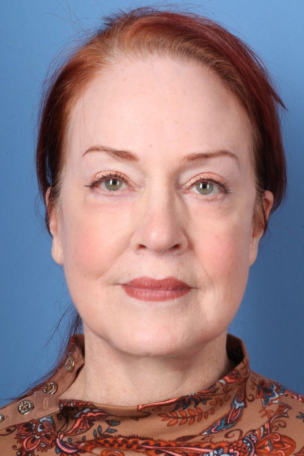 Facelift Before & After Image