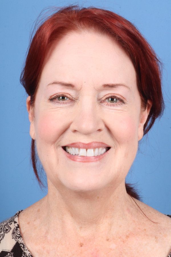 Facelift Before & After Image