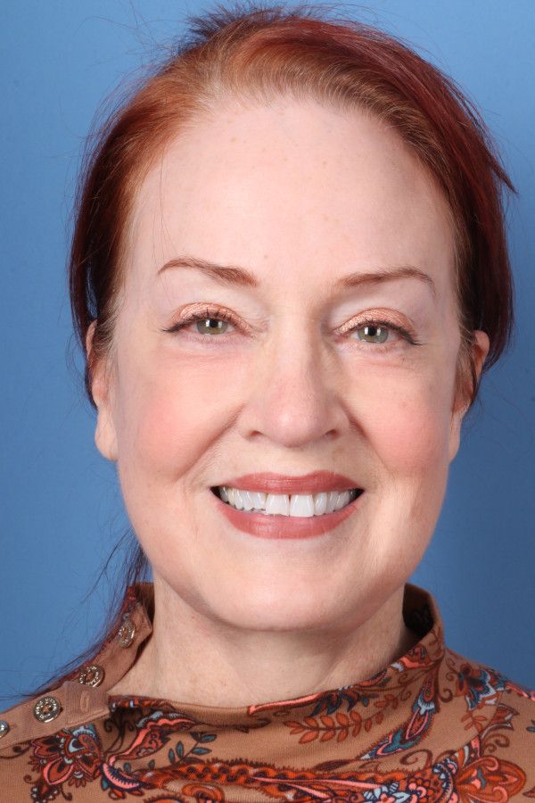 Facelift Before & After Image