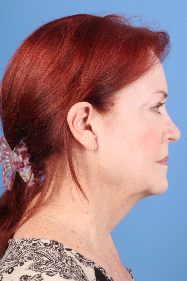 Facelift Before & After Image