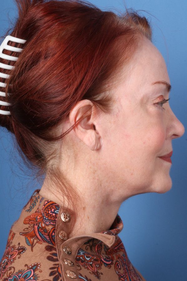 Facelift Before & After Image