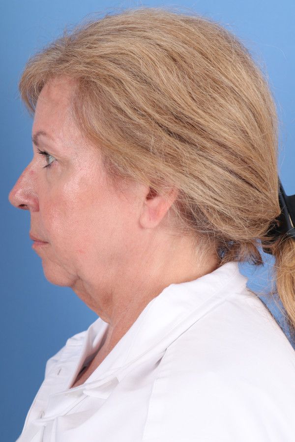Facelift Before & After Image
