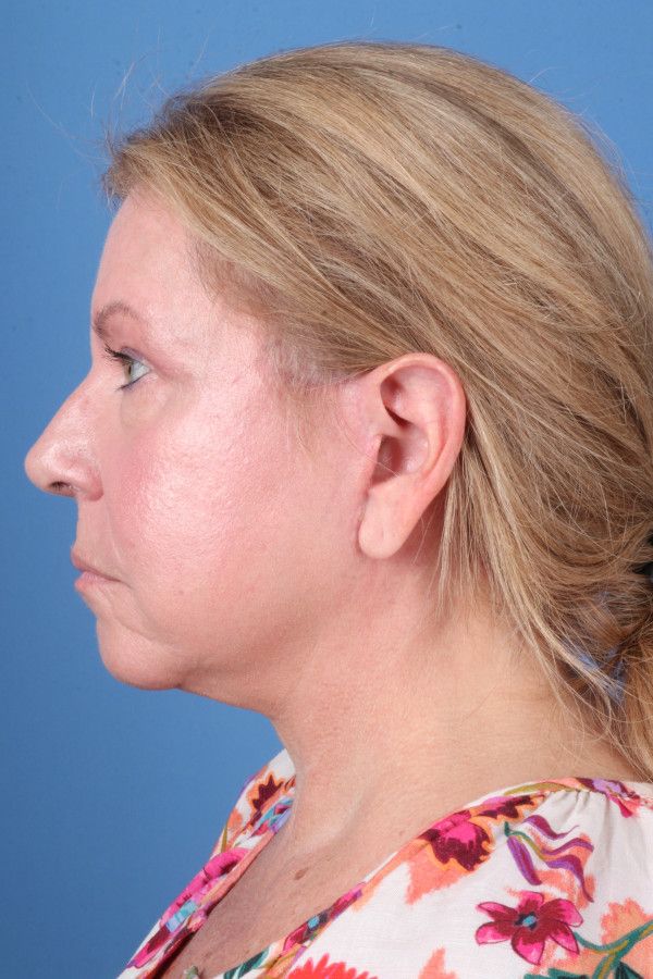 Facelift Before & After Image