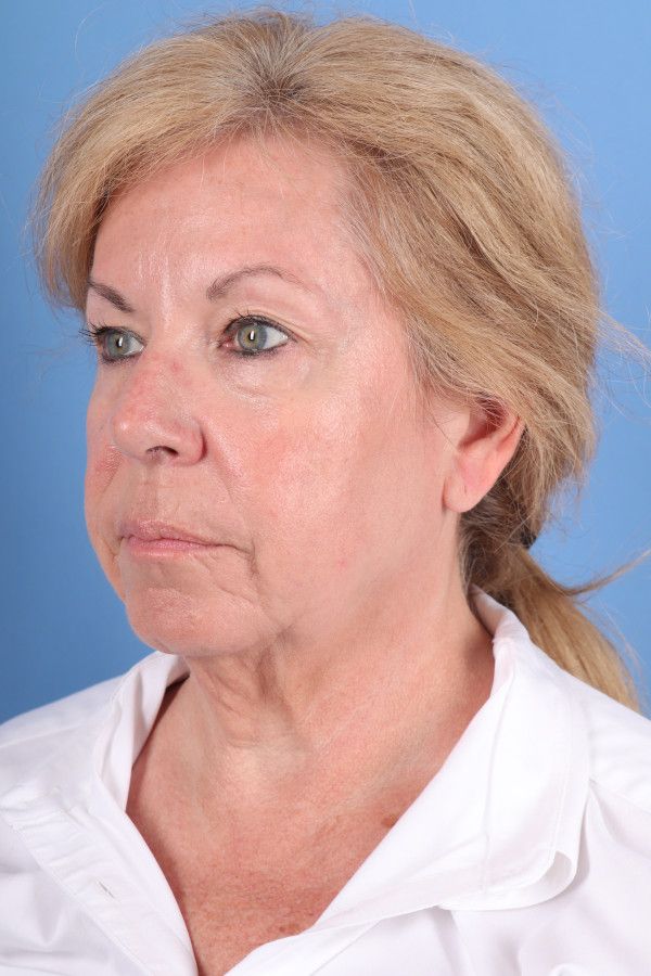 Facelift Before & After Image