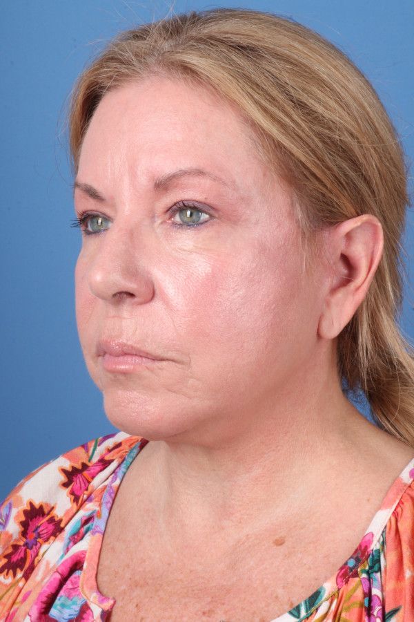 Facelift Before & After Image