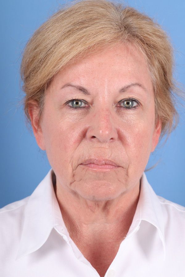 Facelift Before & After Image